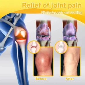 Alcuras™ Botulinum Toxin & Bee Venom Pain-Relief Bone Healing Cream🐝💎