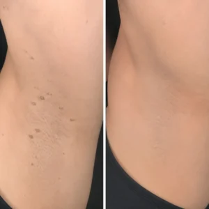 Alcuras®2-in-1 Microneedle & Hydrocolloid Patch🍀| Removes Raised Moles, Acne, Flat Warts & Skin Tags | Helps Improve Wrinkles, Scars & Blemishes | Invisible Patches for Face & Body