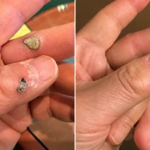 Alcuras®2-in-1 Microneedle & Hydrocolloid Patch🍀| Removes Raised Moles, Acne, Flat Warts & Skin Tags | Helps Improve Wrinkles, Scars & Blemishes | Invisible Patches for Face & Body