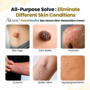 Alcuras® PsoriaSoothe Bee Venom Skin-Restoration Cream