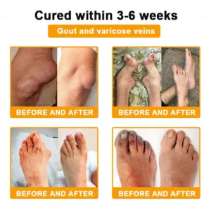 Alcuras® Bee Venom Pain-Relief Bone Healing Cream 🇺🇸(Specially for older adults)