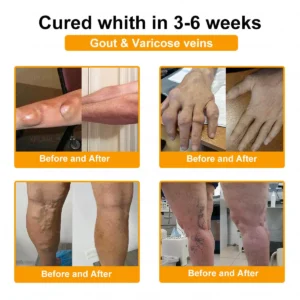 Alcuras® Bee Venom Pain-Relief Bone Healing Cream 🇺🇸(Specially for older adults)
