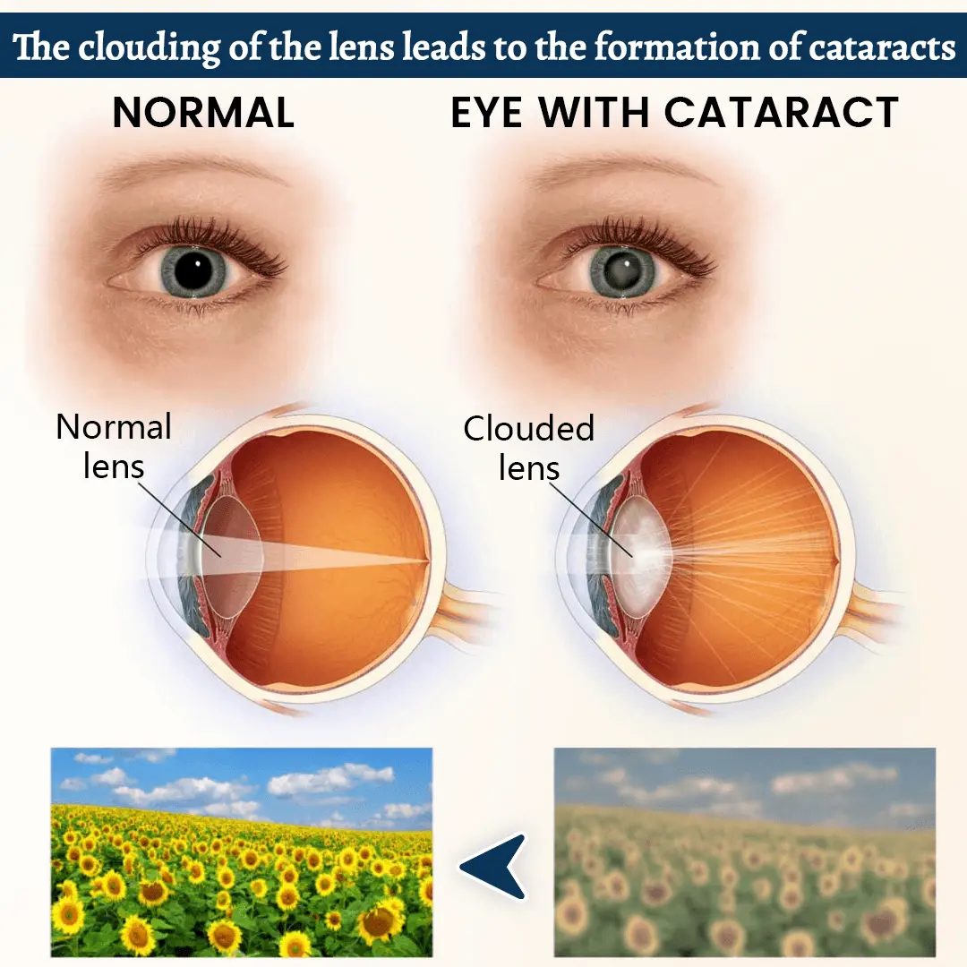 Alcuras® Relieflogix OptiFusion Vision Support Eye Patch