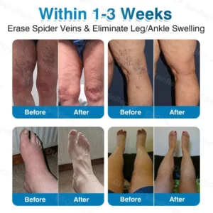 🇦🇺🏆✅️🏃Alcuras® VeinRepair Microneedle Patch Roll⚡Instant Relief, Long-Term Results