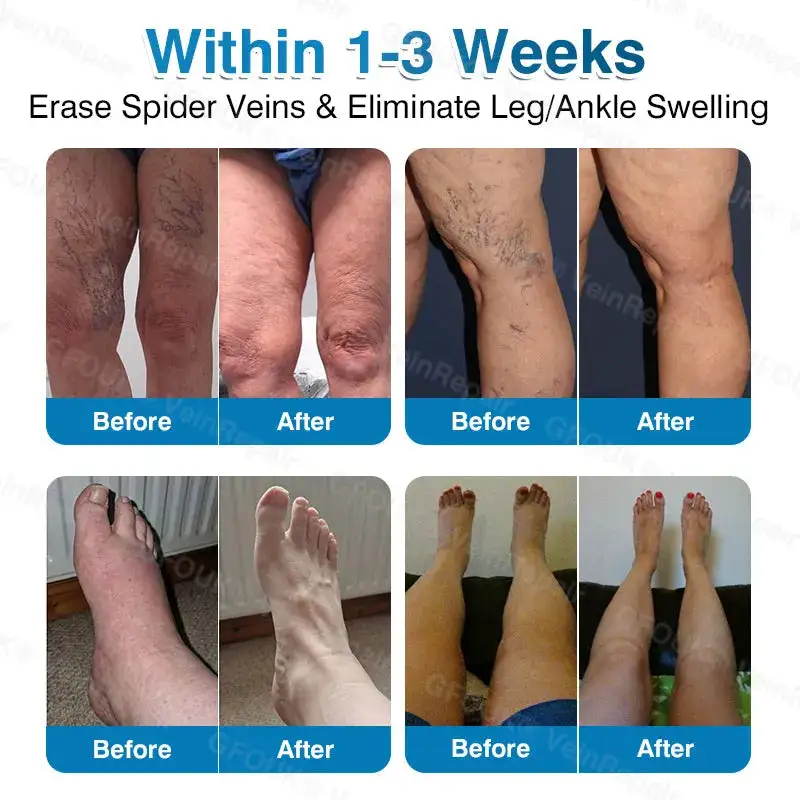 🇦🇺🏆✅️🏃Alcuras® VeinRepair Microneedle Patch Roll⚡Instant Relief, Long-Term Results