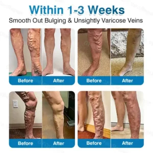 🇦🇺🏆✅️🏃Alcuras® VeinRepair Microneedle Patch Roll⚡Instant Relief, Long-Term Results