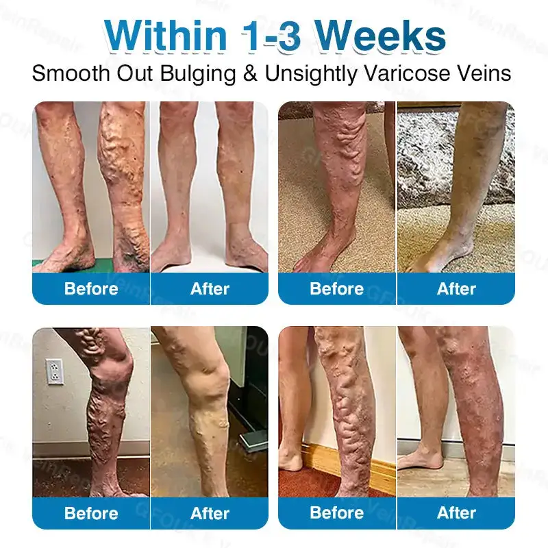 🇦🇺🏆✅️🏃Alcuras® VeinRepair Microneedle Patch Roll⚡Instant Relief, Long-Term Results