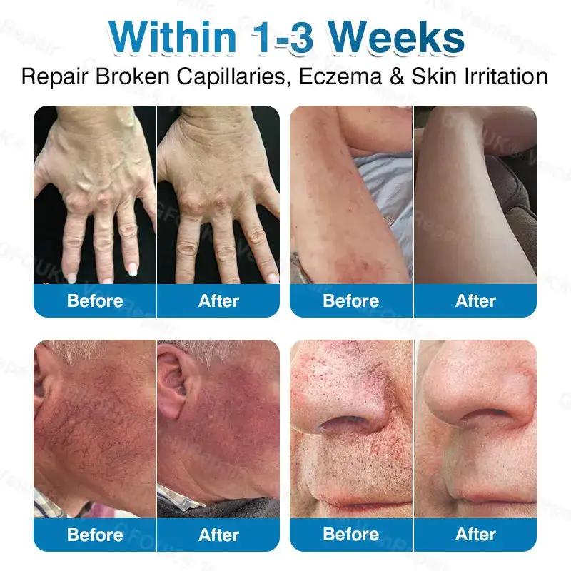 🇦🇺🏆✅️🏃Alcuras® VeinRepair Microneedle Patch Roll⚡Instant Relief, Long-Term Results